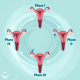 Ovulation