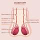 vasectomy