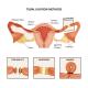 tubectomy