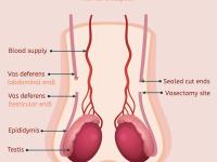 vasectomy