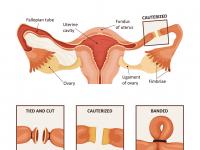 tubectomy