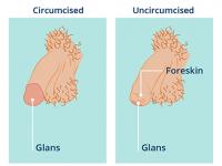 Circumcised and uncircumcised penis