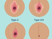 Female genital cutting