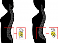 More wedge-shaped vertebra (right) create a sexier bottom curve